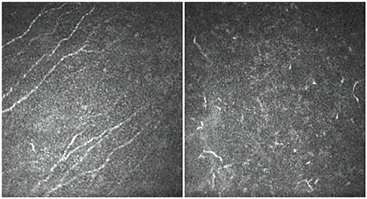 Clinical Study: Aniridia Triggers Progressive Corneal Sensitivity Loss