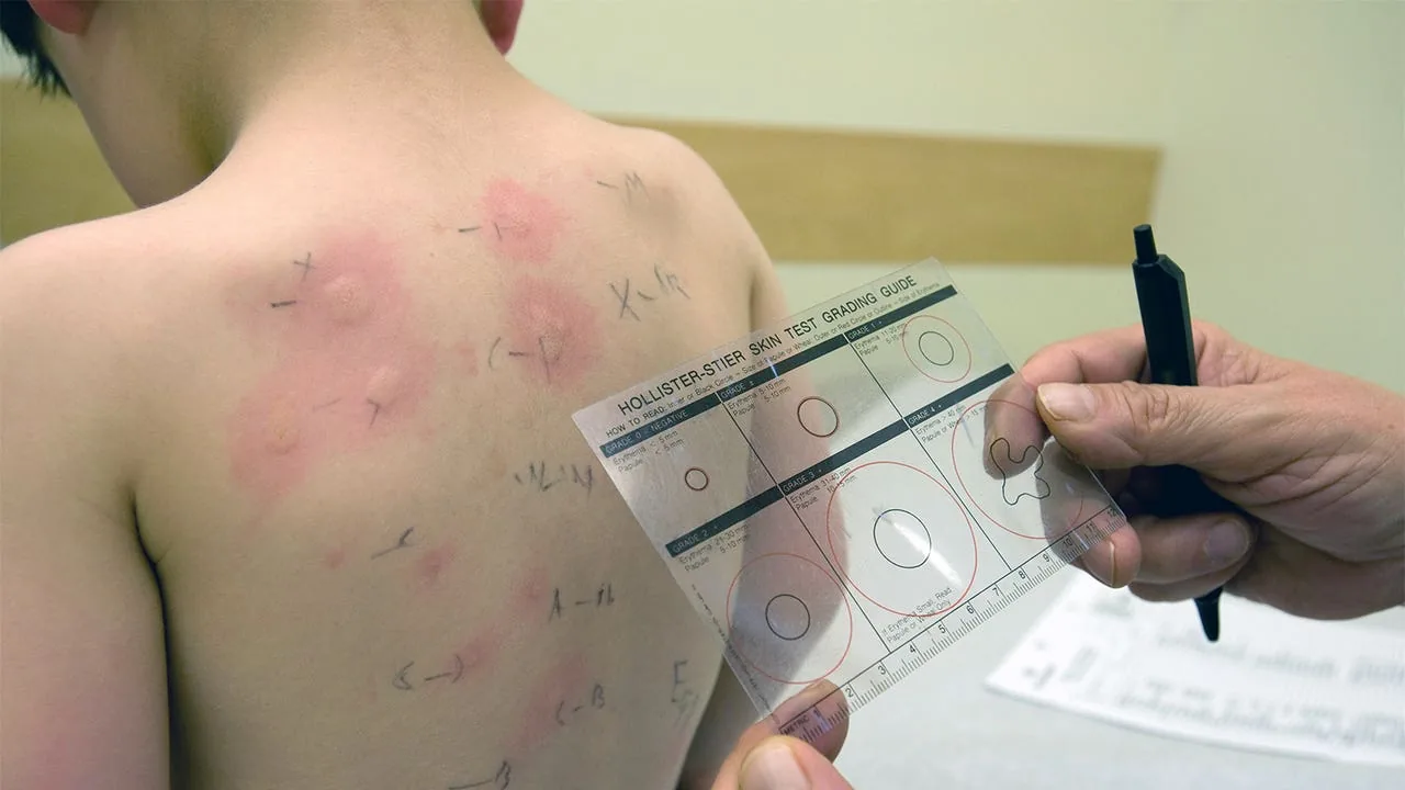 Highest Childhood Food Allergy Rates in US and Australia